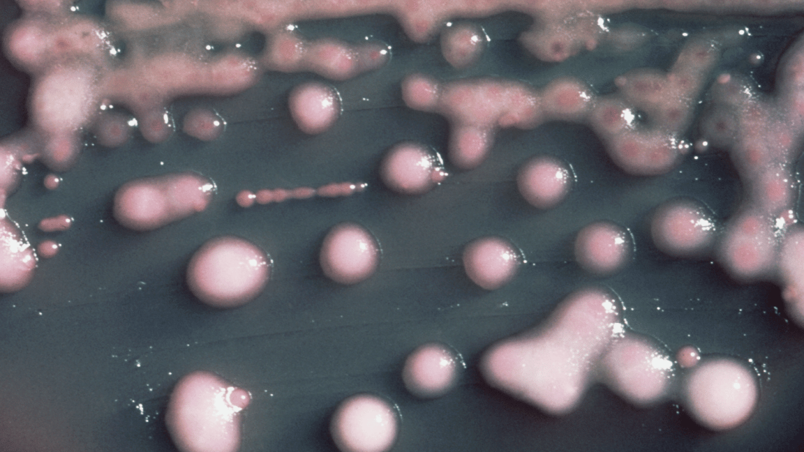 A woman got a UTI. Two years later, the bacteria had evolved, invaded her brain.