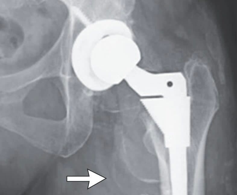 Woman's puzzling decline turns out to be cobalt poisoning from hip replacement