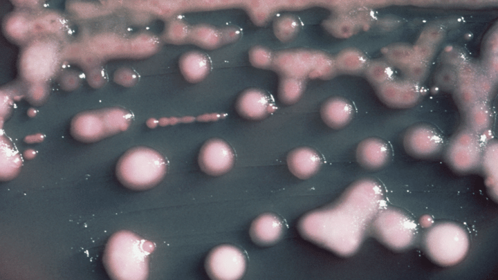 A woman got a UTI. Two years later, the bacteria had evolved, invaded her brain.