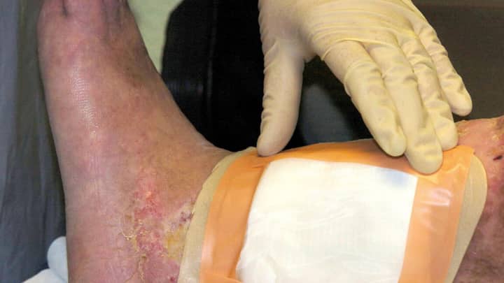 Second carcass-eating fly species cleared by FDA for maggot wound therapy