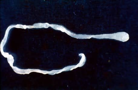 Surprised doctors find 10-inch worm in man's groin during elective surgery
