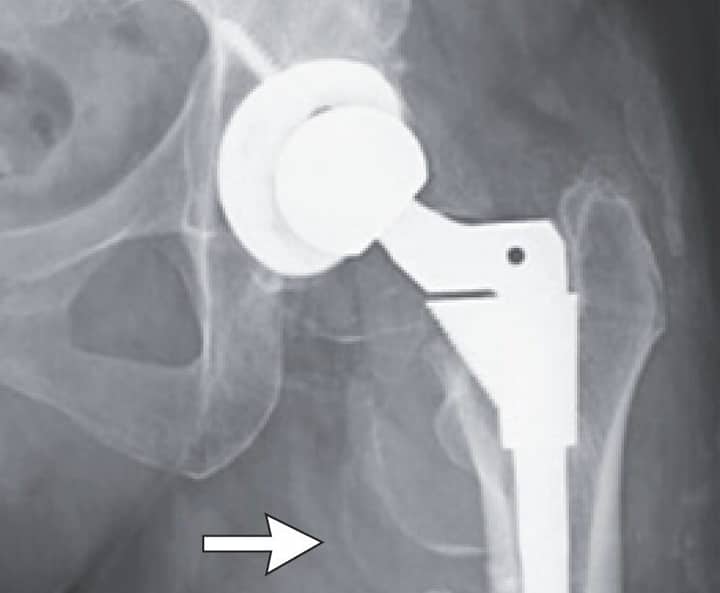Woman's puzzling decline turns out to be cobalt poisoning from hip replacement